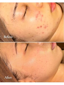 アラモア(ARAMOA)/剥離なし沖縄産ハーブピーリング