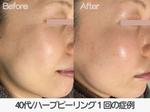 ラ コケット(La Coquette)/敏感肌でもエイジングケアしたい