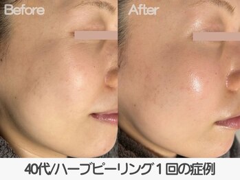 ラ コケット(La Coquette)/敏感肌でもエイジングケアしたい