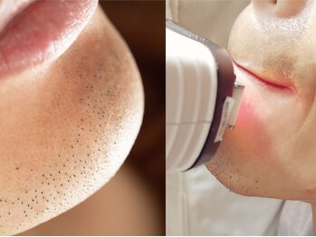 マッサージ整体院 なごみ 桜台店/ひげ脱毛