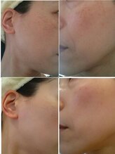 エステティック ブランシュール(Blancheur)/気になるシミ、美白ケアも◎