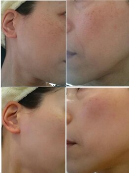 エステティック ブランシュール(Blancheur)/気になるシミ、美白ケアも◎