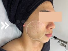 グリーンピール エルモナ(GREENPEEL ELMONA)/【グリーンピールレスベラ】