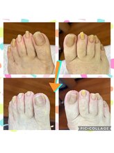 Dr.ネイル爪革命 静岡沼津店/爪切り・肥厚爪ケア