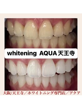 アクア 天王寺店(AQUA)/セルフホワイトニング/天王寺