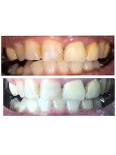 ティースクリーン(Teeth Clean)/60代でも歯を白く！健康に！