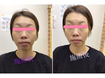うちんだい整骨院 整体院/40代女性/小顔矯正 施術事例