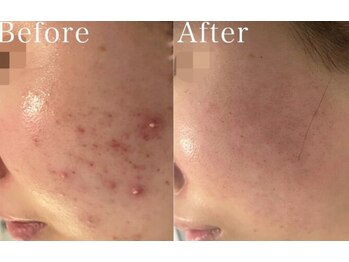 ホヌ(Honu)/白ニキビや頬の赤みも改善^_^