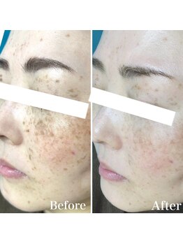 パールホワイトニングサロン 大和店/ハーブピーリングホワイトニング