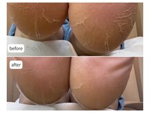 カシェット(Cachette)/50代女性◎足裏角質ケア90分