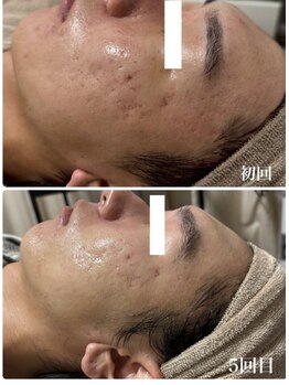 ビズビズ(bisebise)/メンズニキビ肌荒れ5回症例