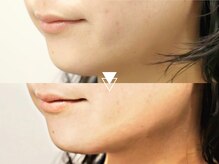 【瞬間リフト×小顔】微弱電流でむくみ・たるみを徹底ケア！シャープなVラインに◎小顔バイオリフト￥9980