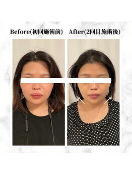 ザビューティー 麻布十番本店(The Beauty)/12Dリフト全顔打ち放題[リフト]