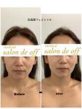 メディカルサロンドオフ 堺東店(medical salon de off)/光造顔フェイシャル★ &nbsp;施術前後