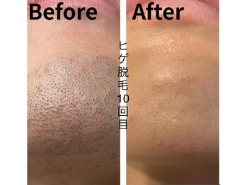 CDF 赤坂/メンズヒゲ脱毛10回目初回￥1000