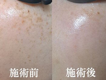 エレヌイ(ELENUI)/最新光フェイシャル★シミ改善