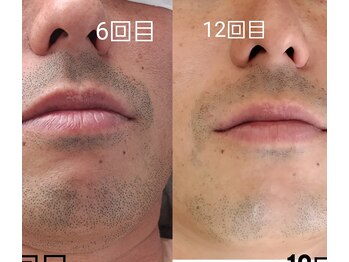 エイプリルプラス(April plus)/ヒゲ脱毛　