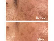 MMK/頑固な悩みにもハーブピーリング