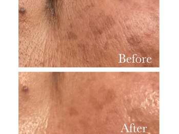 MMK/頑固な悩みにもハーブピーリング