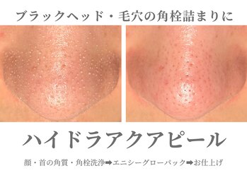 エクラ イオンモール徳島店(ECLAT)/ハイドラアクアピール+CO2パック