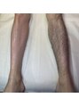 エヴァワックス 錦糸町店(EvaWax)&nbsp;メンズ脚オール脱毛before/after【メンズブラジリアンワックス】