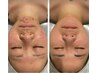 【20代のニキビ悩みへ】ニキビアンプル導入★アクアダーマでトラブルケア
