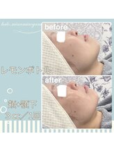 ハロ 南青山(HALO)/小顔レモンボトル3cc