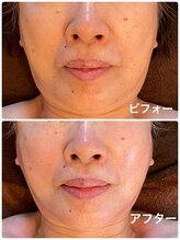 ナオフクオカ ヒーリングフォースエヌ(NaoFukuoka/healingforceN)/70代　小顔コルギでリフトアップ