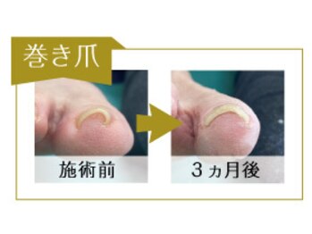 リフト 有楽町店(Re:ft)/巻き爪症例