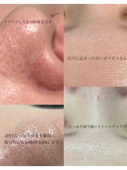 ヴィーナス(Venus)/フェイシャルWAX