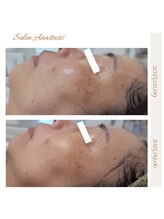 アナスタシス(Anastasis)/フェイシャル