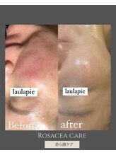 アルメ(arme)/【赤ら顔ケア】