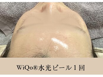 ソーヴ(SOLVE)/WiQo水光ピーリング１回で艶肌