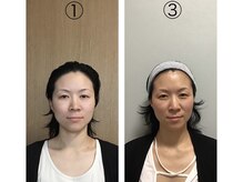 マカニ 河原町御池(makani)/小顔矯正ビフォーアフター