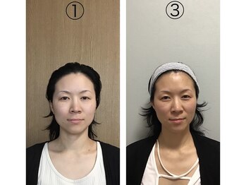 マカニ 河原町御池(makani)/小顔矯正ビフォーアフター