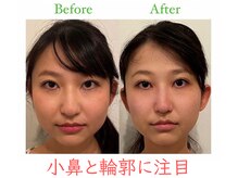 【美鼻/小顔】日本隆鼻矯正協会認定サロンにしかできない高技術