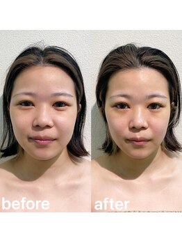 リニューサロン 本院(renew salon)/小顔矯正+デコルテマッサージ