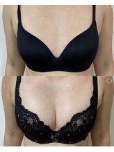 デミーナ(Demyna)/【バストアップ】症例 育乳