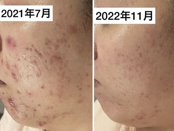 サロンヴェアリー 広尾(salon vary)/ブライダルに向けて徹底肌改善！