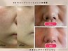【毛穴開き・黒ずみケア◎】ハーブピーリング（顔首）ヘッドケア付き☆50分