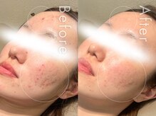 セルフミー 恵比寿(SELF Me...)/ハーブピーリング/ニキビケア