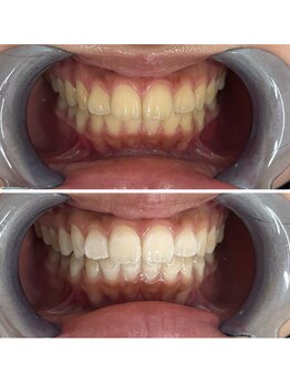 グリッター ショウナン(glitter. SHONAN)/歯のホワイトニングbefore/after