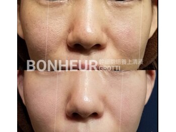 ボヌール 名古屋 覚王山店(BONHEUR)/GROTTO PROを使用した幹細胞ケア