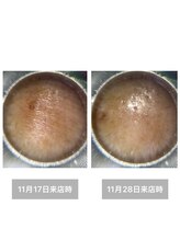 雪中花ナルシサス(narcisse)/額のしわ、施術前→施術後10日