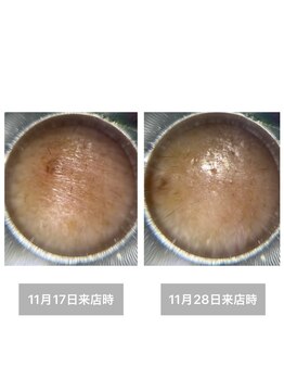 雪中花ナルシサス(narcisse)/額のしわ、施術前→施術後10日