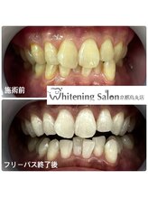 ホワイトニングサロン 京都烏丸店/ホワイトニング施術例