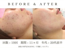 ロエヴェ(ROEWE)/ニキビ改善・毛穴ケア・肌質改善