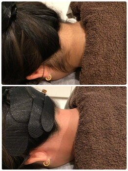 ビープラス(B plus)/うなじWAX脱毛で理想のうなじへ