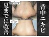 《背中黒ずみ/ニキビケア》剥離有り.リベルハーブピーリング(上部分)¥30000→