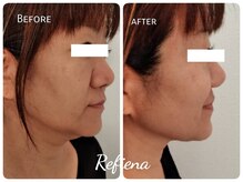 しみ改善サロン リフィーナ/二重あごのお悩みはコンビ！